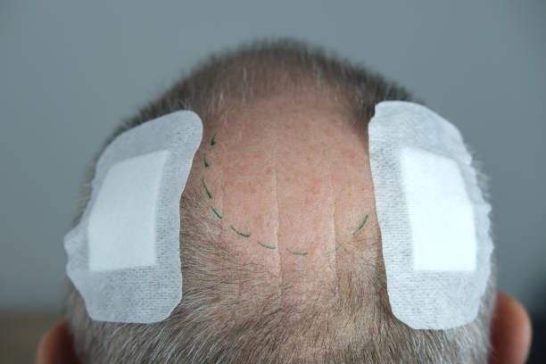 نمایش نتایج کاشت مو و مشاوره تخصصی در وبسایت کلینیک