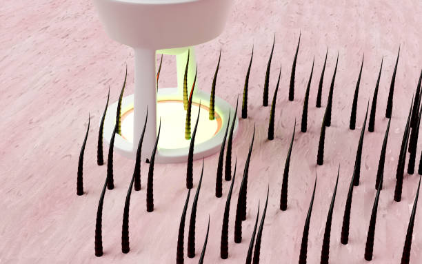 نمایش سه بعدی تبلیغات لیزر موهای زائد برای سالن زیبایی. استراتژی بازاریابی کلینیک، سئوی مراکز زیبایی