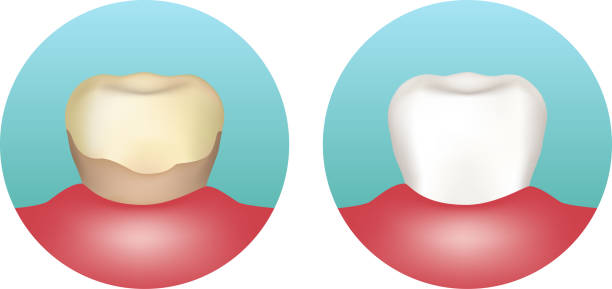 تصویر مقایسه دندان زرد و جرم گرفته با دندان سفید و سالم - طراحی سایت دندانپزشکی، سئو محلی کلینیک، سیستم رزرواسیون هوشمند پزشکی