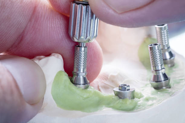 ایمپلنت دندانپزشکی در تبریز: طراحی UX دندانپزشکی و بهبود تجربه کاربری بیماران با نوبتدهی آنلاین