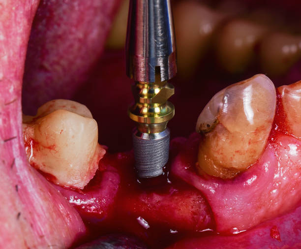 پشتیبانی سایت کلینیک ایمپلنت دندانپزشکی در مشهد - ایمپلنت دندان