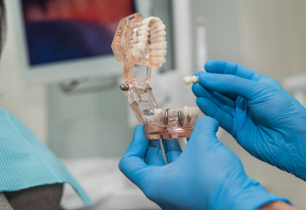 پروتز دندان در دست متخصص ایمپلنت - سئو ایمپلنت دندان و افزایش اعتماد بیمار